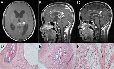 Multiple ectopic recurrent germ cell tumors after total pineal mature teratoma removal: A case report and literature review